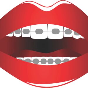 Lips Braces 1 Thumbnail